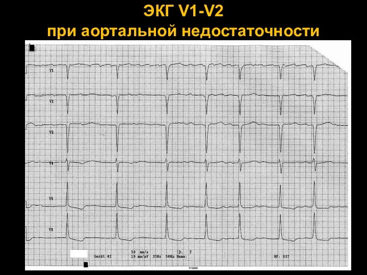 ЭКГ V1-V2 при аортальной недостаточности