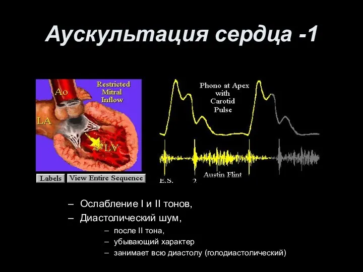 Аускультация сердца -1 Ослабление I и II тонов, Диастолический шум,