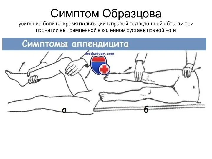 Симптом Образцова усиление боли во время пальпации в правой подвздошной