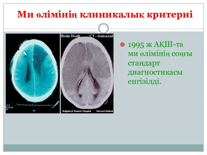 Ми өлімінің клиникалық критериі 1995 ж АҚШ-та ми өлімінің соңғы стандарт диагностикасы енгізілді.