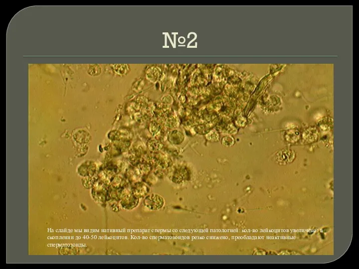 №2 На слайде мы видим нативный препарат спермы со следующей патологией: кол-во лейкоцитов