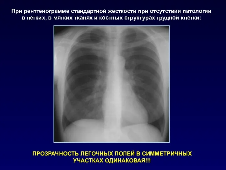 При рентгенограмме стандартной жесткости при отсутствии патологии в легких, в