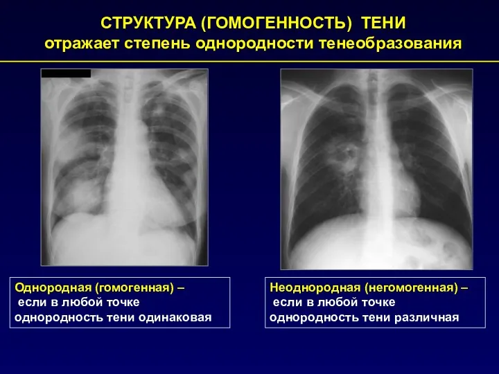 СТРУКТУРА (ГОМОГЕННОСТЬ) ТЕНИ отражает степень однородности тенеобразования Однородная (гомогенная) –