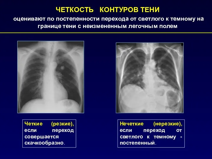 ЧЕТКОСТЬ КОНТУРОВ ТЕНИ оценивают по постепенности перехода от светлого к