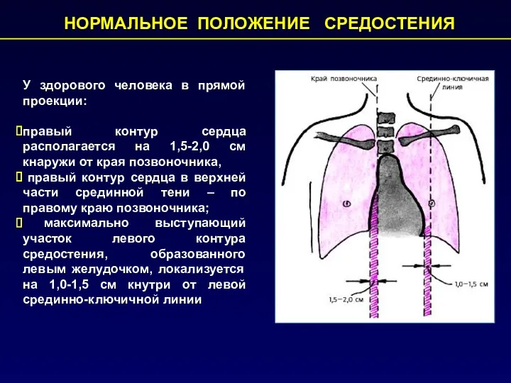 НОРМАЛЬНОЕ ПОЛОЖЕНИЕ СРЕДОСТЕНИЯ У здорового человека в прямой проекции: правый