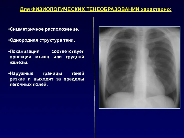 Для ФИЗИОЛОГИЧЕСКИХ ТЕНЕОБРАЗОВАНИЙ характерно: Симметричное расположение. Однородная структура тени. Локализация