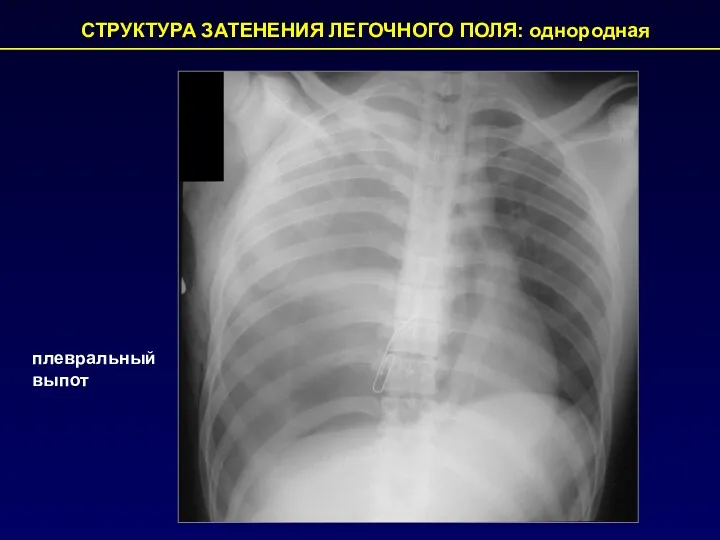 плевральный выпот СТРУКТУРА ЗАТЕНЕНИЯ ЛЕГОЧНОГО ПОЛЯ: однородная