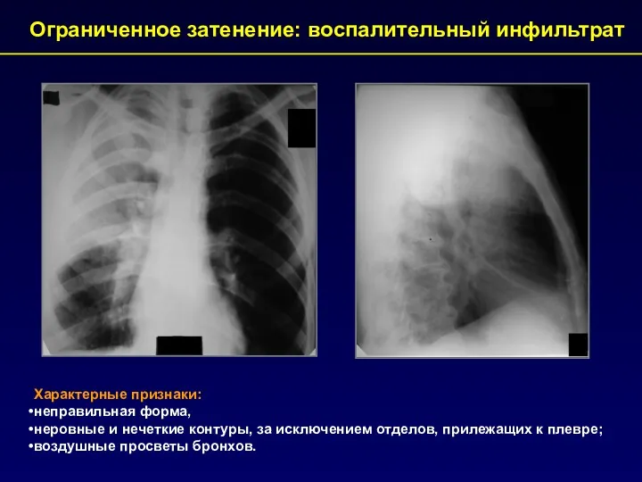 Характерные признаки: неправильная форма, неровные и нечеткие контуры, за исключением