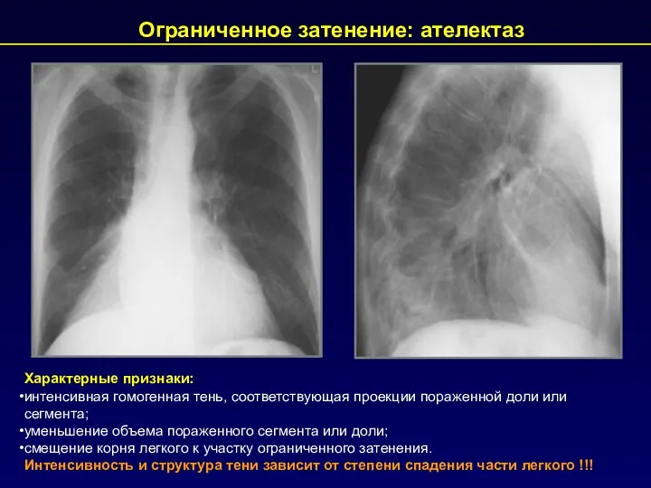 Характерные признаки: интенсивная гомогенная тень, соответствующая проекции пораженной доли или