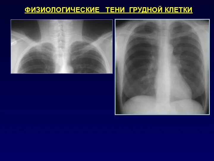 ФИЗИОЛОГИЧЕСКИЕ ТЕНИ ГРУДНОЙ КЛЕТКИ