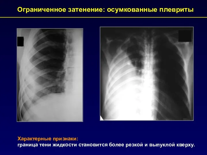 Характерные признаки: граница тени жидкости становится более резкой и выпуклой кверху. Ограниченное затенение: осумкованные плевриты