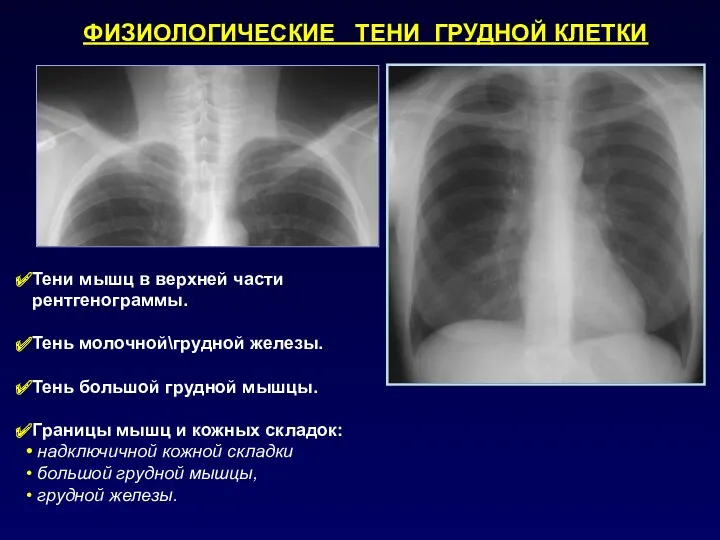 ФИЗИОЛОГИЧЕСКИЕ ТЕНИ ГРУДНОЙ КЛЕТКИ Тени мышц в верхней части рентгенограммы.