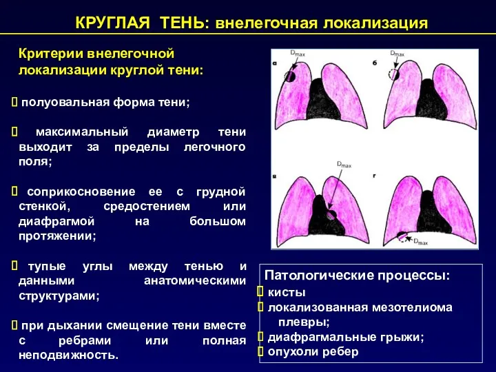 КРУГЛАЯ ТЕНЬ: внелегочная локализация Патологические процессы: кисты локализованная мезотелиома плевры;