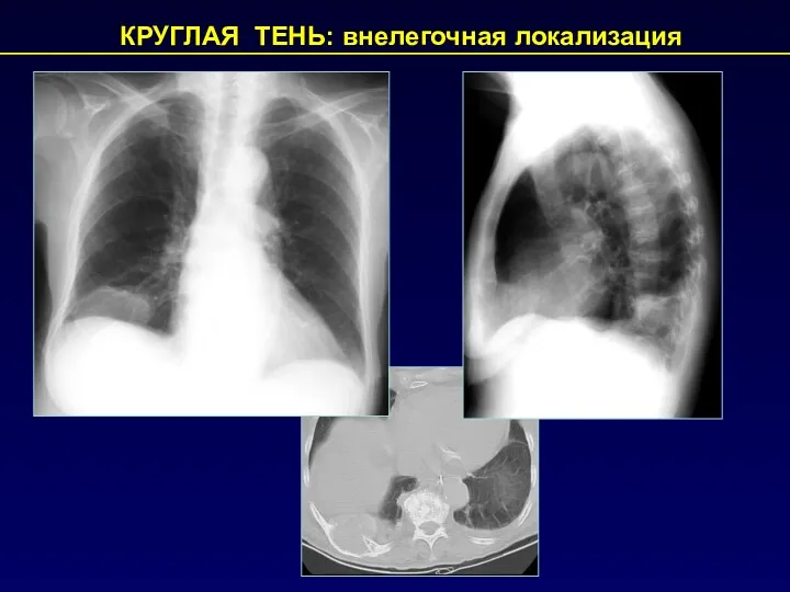 КРУГЛАЯ ТЕНЬ: внелегочная локализация