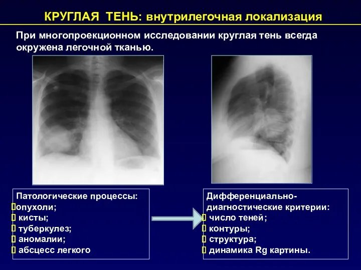 КРУГЛАЯ ТЕНЬ: внутрилегочная локализация При многопроекционном исследовании круглая тень всегда