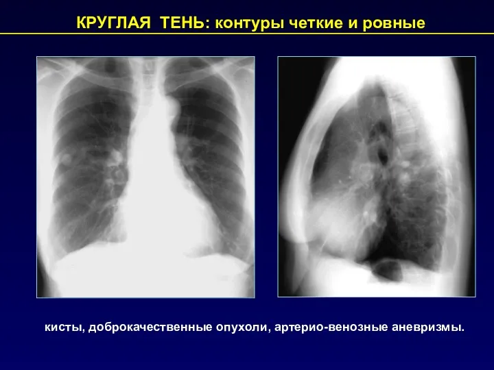 КРУГЛАЯ ТЕНЬ: контуры четкие и ровные кисты, доброкачественные опухоли, артерио-венозные аневризмы.