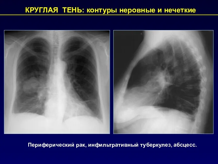 КРУГЛАЯ ТЕНЬ: контуры неровные и нечеткие Периферический рак, инфильтративный туберкулез, абсцесс.