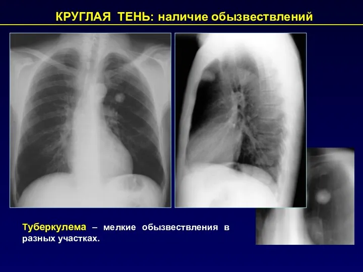 КРУГЛАЯ ТЕНЬ: наличие обызвествлений Туберкулема – мелкие обызвествления в разных участках.