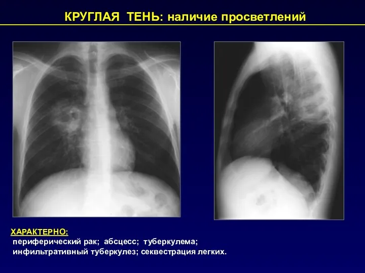 КРУГЛАЯ ТЕНЬ: наличие просветлений ХАРАКТЕРНО: периферический рак; абсцесс; туберкулема; инфильтративный туберкулез; секвестрация легких.