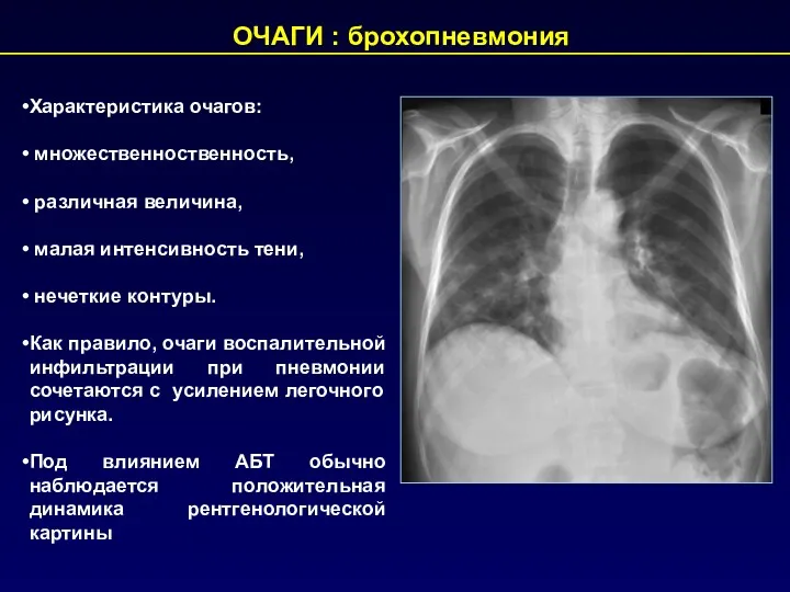 Характеристика очагов: множественноственность, различная величина, малая интенсивность тени, нечеткие контуры.