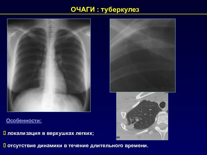 ОЧАГИ : туберкулез Особенности: локализация в верхушках легких; отсутствие динамики в течение длительного времени.