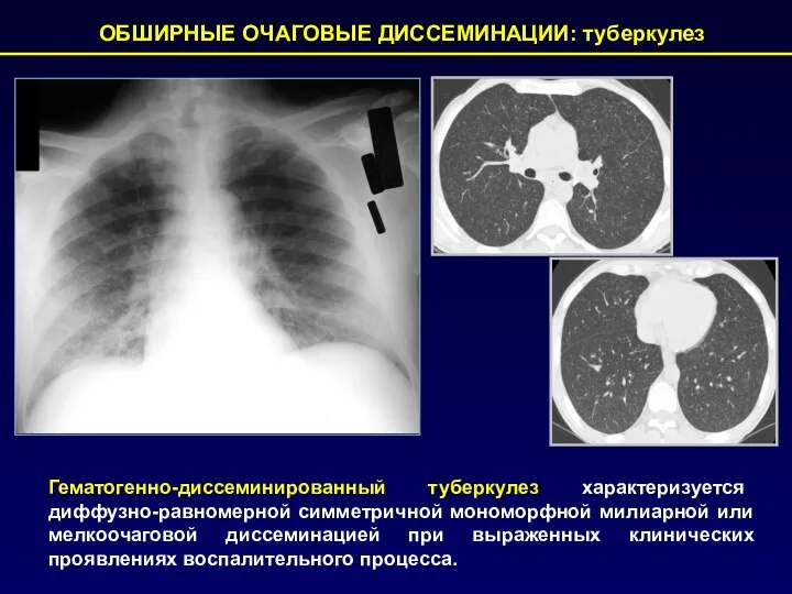 ОБШИРНЫЕ ОЧАГОВЫЕ ДИССЕМИНАЦИИ: туберкулез Гематогенно-диссеминированный туберкулез характеризуется диффузно-равномерной симметричной мономорфной милиарной или мелкоочаговой