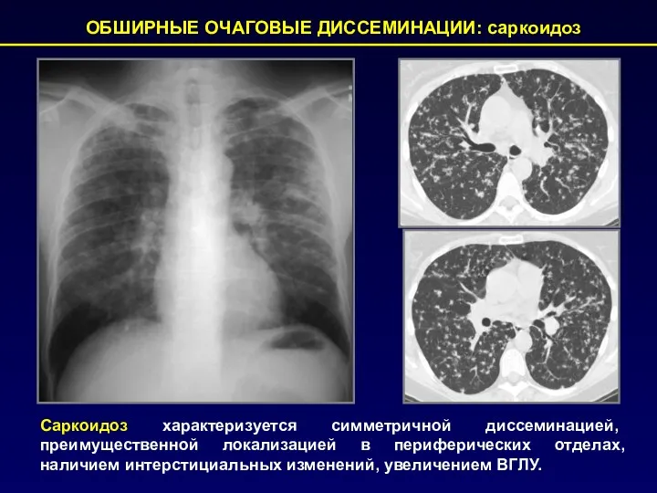 ОБШИРНЫЕ ОЧАГОВЫЕ ДИССЕМИНАЦИИ: саркоидоз Саркоидоз характеризуется симметричной диссеминацией, преимущественной локализацией