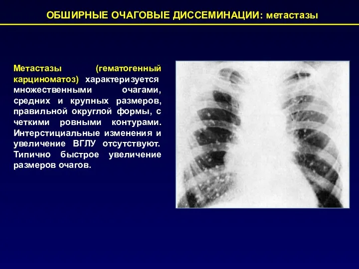 ОБШИРНЫЕ ОЧАГОВЫЕ ДИССЕМИНАЦИИ: метастазы Метастазы (гематогенный карциноматоз) характеризуется множественными очагами,