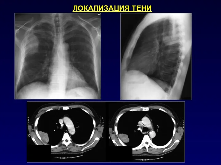 ЛОКАЛИЗАЦИЯ ТЕНИ