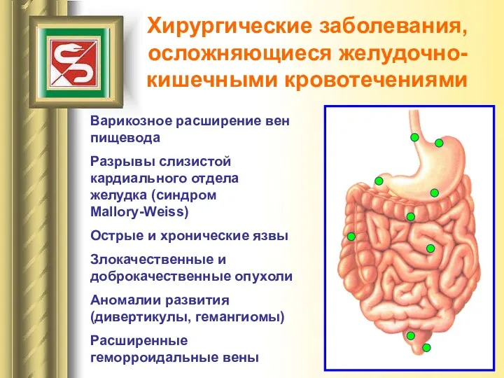 Хирургические заболевания, осложняющиеся желудочно-кишечными кровотечениями Варикозное расширение вен пищевода Разрывы