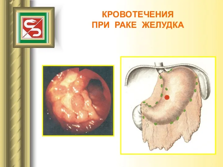 КРОВОТЕЧЕНИЯ ПРИ РАКЕ ЖЕЛУДКА