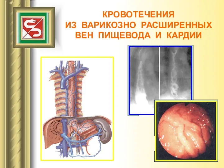 КРОВОТЕЧЕНИЯ ИЗ ВАРИКОЗНО РАСШИРЕННЫХ ВЕН ПИЩЕВОДА И КАРДИИ