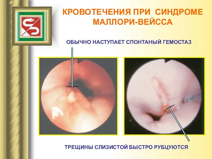 КРОВОТЕЧЕНИЯ ПРИ СИНДРОМЕ МАЛЛОРИ-ВЕЙССА ОБЫЧНО НАСТУПАЕТ СПОНТАНЫЙ ГЕМОСТАЗ ТРЕЩИНЫ СЛИЗИСТОЙ БЫСТРО РУБЦУЮТСЯ