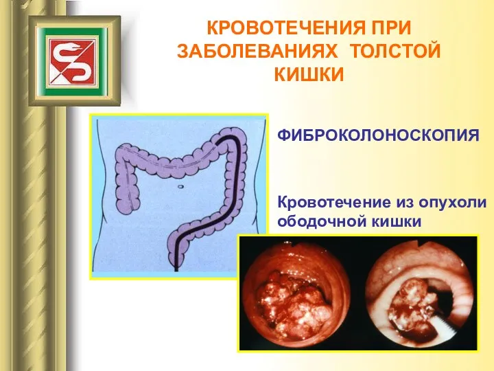 КРОВОТЕЧЕНИЯ ПРИ ЗАБОЛЕВАНИЯХ ТОЛСТОЙ КИШКИ ФИБРОКОЛОНОСКОПИЯ Кровотечение из опухоли ободочной кишки