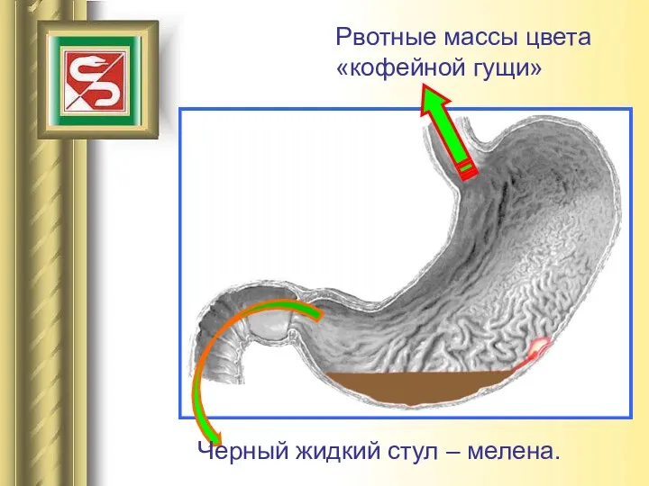 HCl Рвотные массы цвета «кофейной гущи» Черный жидкий стул – мелена.