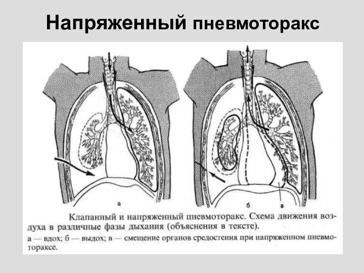 Напряженный пневмоторакс