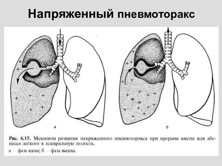 Напряженный пневмоторакс