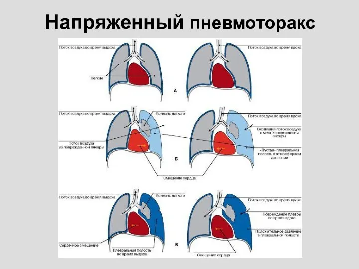 Напряженный пневмоторакс