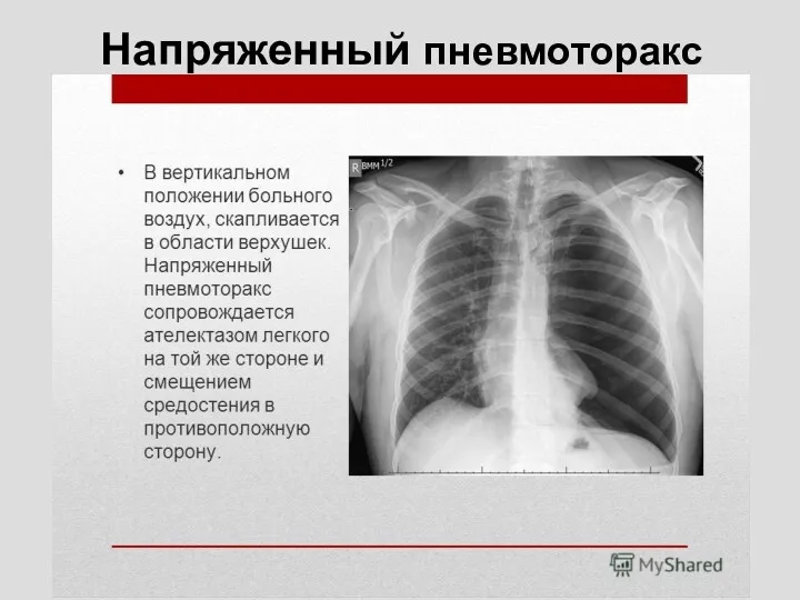 Напряженный пневмоторакс