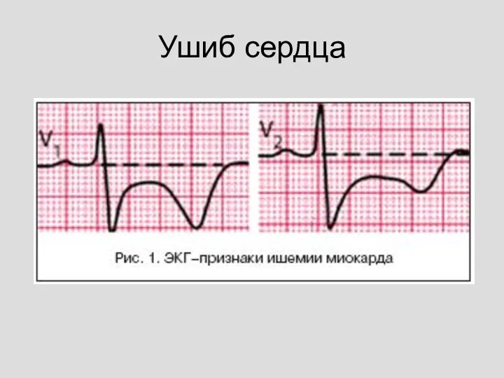 Ушиб сердца