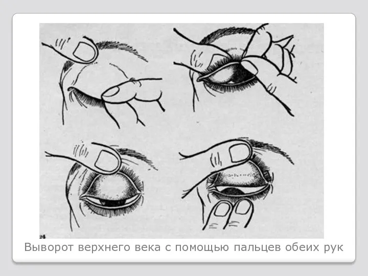 Выворот верхнего века с помощью пальцев обеих рук