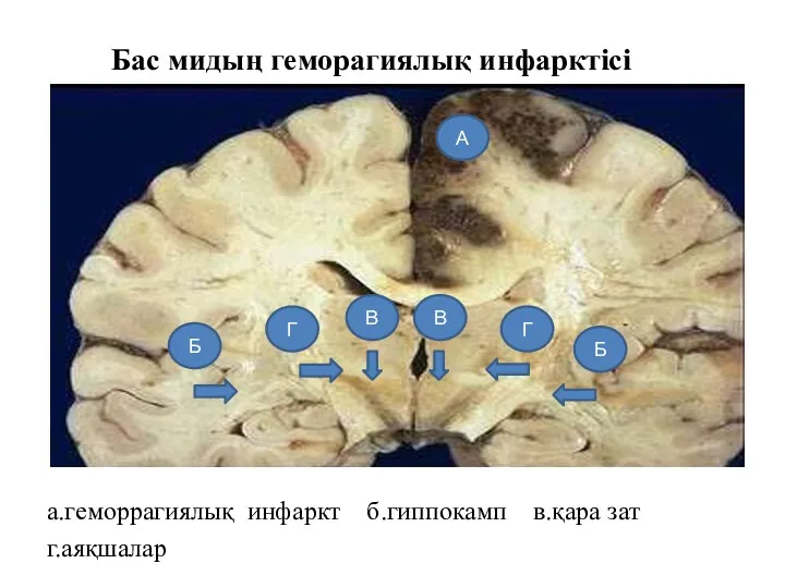 Бас мидың геморагиялық инфарктісі а.геморрагиялық инфаркт б.гиппокамп в.қара зат г.аяқшалар