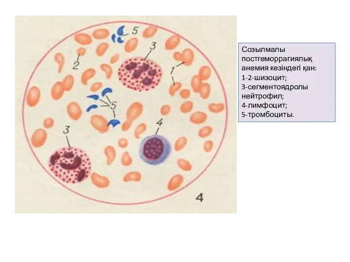 Созылмалы постгеморрагиялық анемия кезіндегі қан: 1-2-шизоцит; 3-сегментоядролы нейтрофил; 4-лимфоцит; 5-тромбоциты.