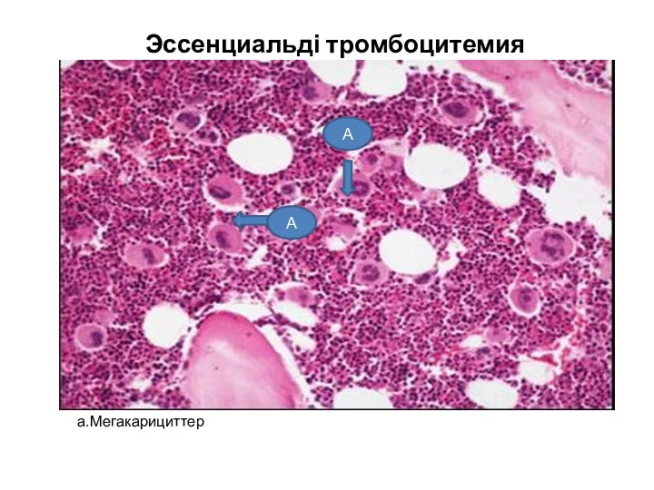 Эссенциальді тромбоцитемия а.Мегакарициттер А А