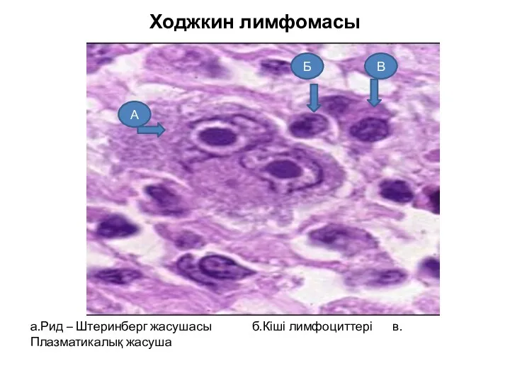 Ходжкин лимфомасы а.Рид – Штеринберг жасушасы б.Кіші лимфоциттері в.Плазматикалық жасуша В А Б