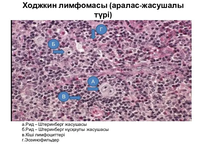 Ходжкин лимфомасы (аралас-жасушалы түрі) а.Рид – Штеринберг жасушасы б.Рид –