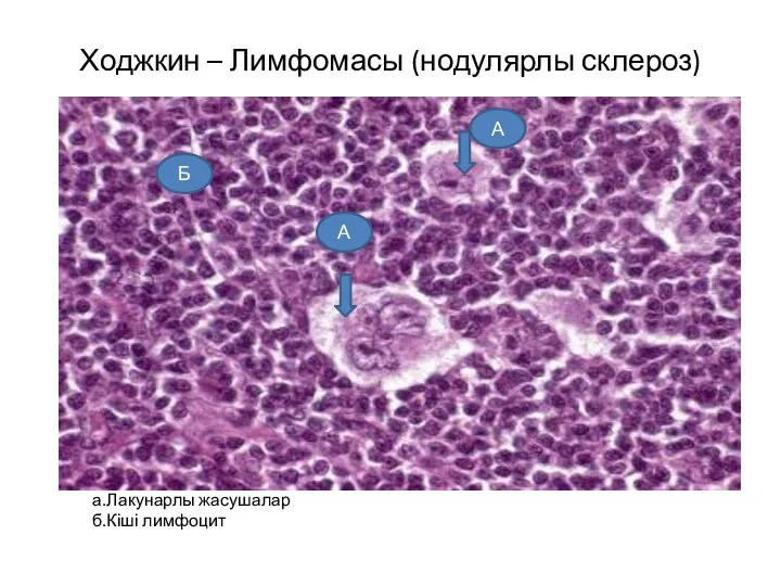 Ходжкин – Лимфомасы (нодулярлы склероз) а.Лакунарлы жасушалар б.Кіші лимфоцит А А Б