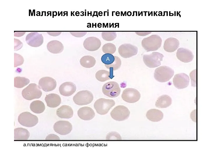 Малярия кезіндегі гемолитикалық анемия а.плазмодияның сакиналы формасы А