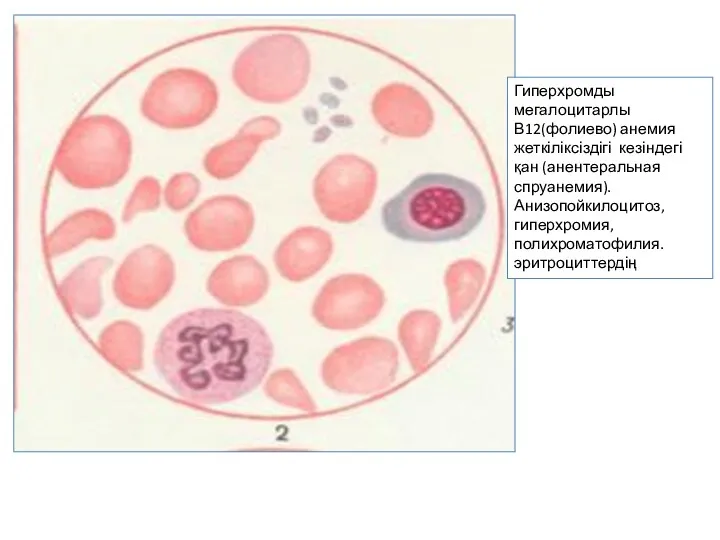 Гиперхромды мегалоцитарлы В12(фолиево) анемия жеткіліксіздігі кезіндегі қан (анентеральная спруанемия). Анизопойкилоцитоз, гиперхромия, полихроматофилия. эритроциттердің