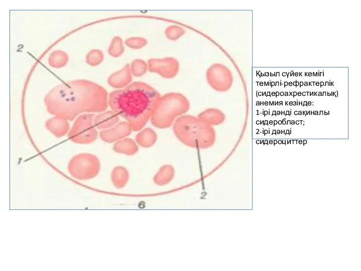 Қызыл сүйек кемігі темірлі-рефрактерлік (сидероахрестикалық) анемия кезінде: 1-ірі дәнді сақиналы сидеробласт; 2-ірі дәнді сидероциттер